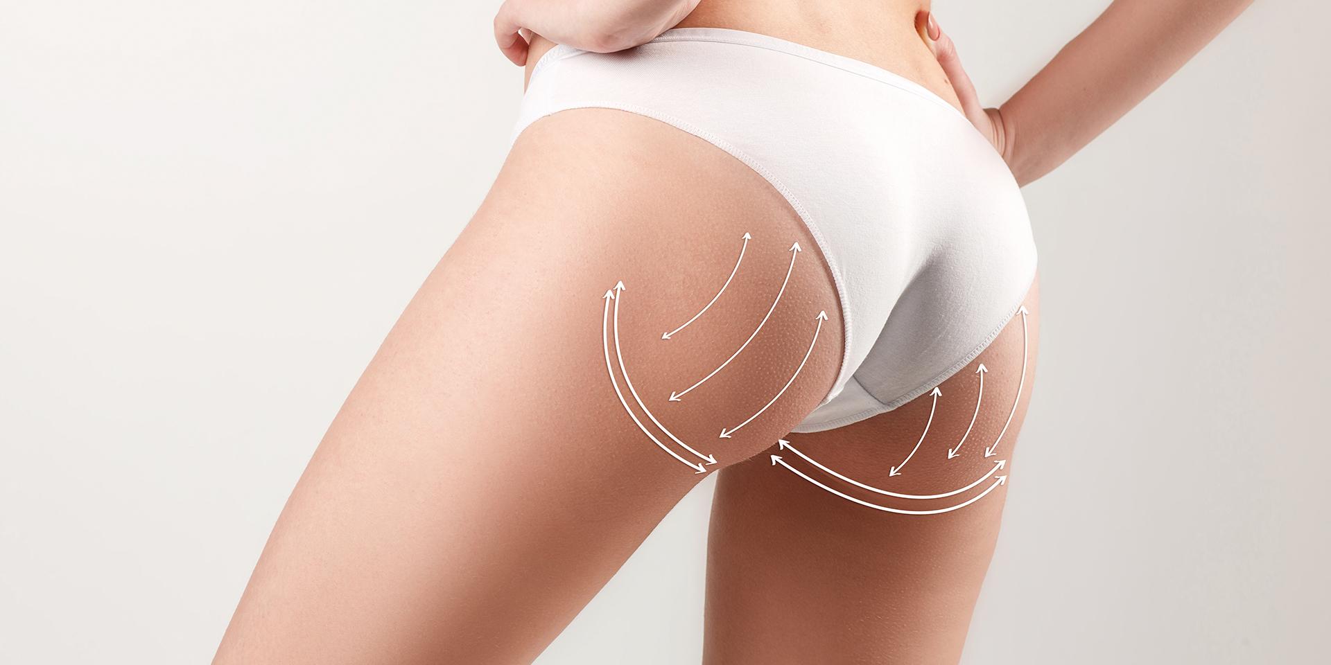 Aumento de gluteos