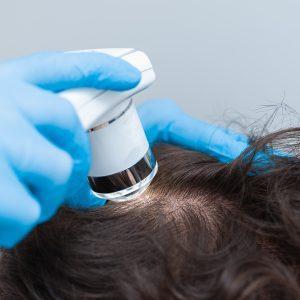 Tratamiento para alopecia
